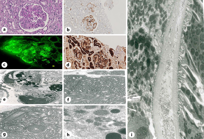 The Matter of Kidney Biopsy in Monoclonal Gammopathy of Renal Significance: A Case Report of a New Pattern of Immunoglobulin-Storing Histiocytosis.