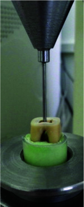 Effect of Incorporating Titanium Dioxide Nanoparticles into White Portland Cement, White Mineral Trioxide Aggregate, and Calcium Enriched Mixture Cement on the Push-out Bond Strength to Furcal Area Dentin.