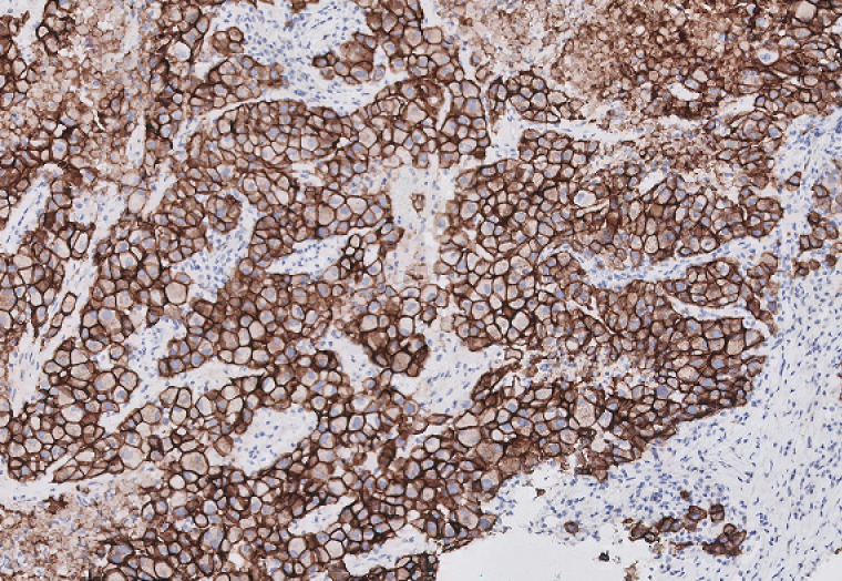 Melanoma in the Breast: A Diagnostic Challenge.
