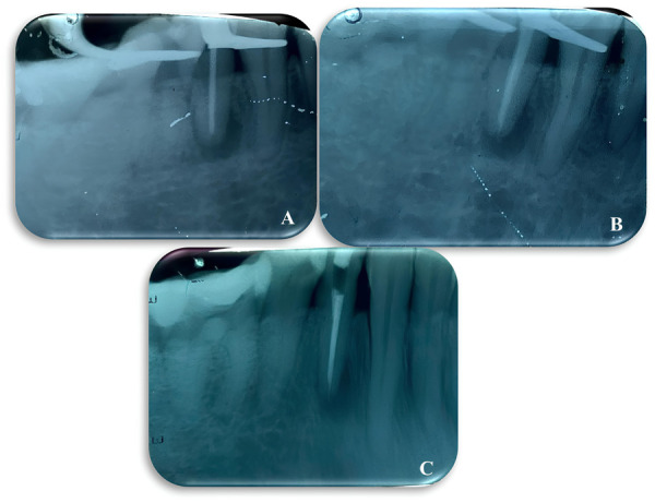 [Effectiveness of an irrigant in the chronic periapical abscess management: a case report].