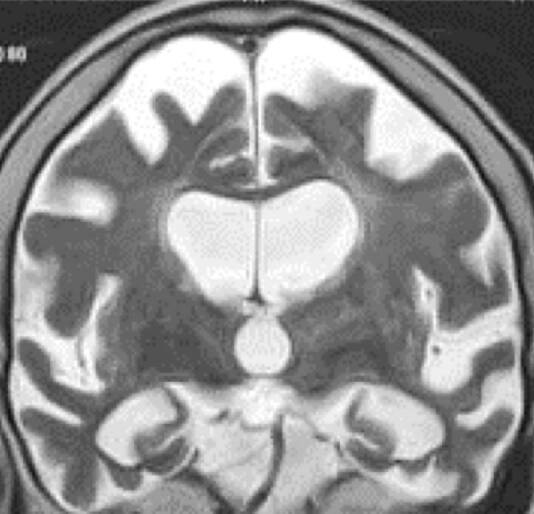 Crossed aphasia in a left-handed patient with non-fluent variant of primary progressive aphasia with left asymmetric brain SPECT.