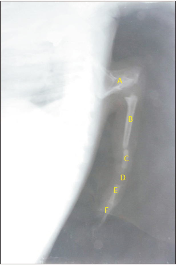 Polymelia (thoracomelia), an extremely rare appearance of congenital anomalic limb in a Nepalese child and its embryological basis.