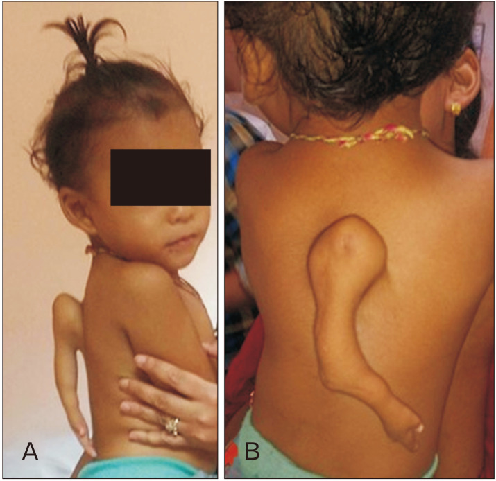 Polymelia (thoracomelia), an extremely rare appearance of congenital anomalic limb in a Nepalese child and its embryological basis.