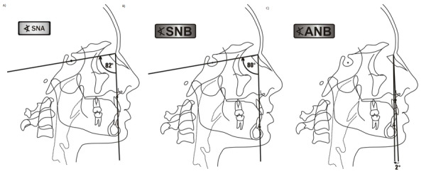 [Comparison of pharyngeal airway space on lateral head radiographs of skeletal class I and II individuals].