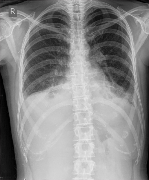 Toxic Cardiomyopathy in a Young Patient Treated for Her2-Positive Early Breast Cancer: Case Report and Literature Review.