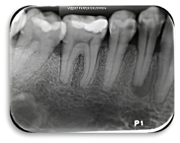 [Effectiveness of an irrigant in the chronic periapical abscess management: a case report].