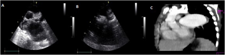 Infectious endarteritis in aortic coarctation: two spectra of an infrequent disease.