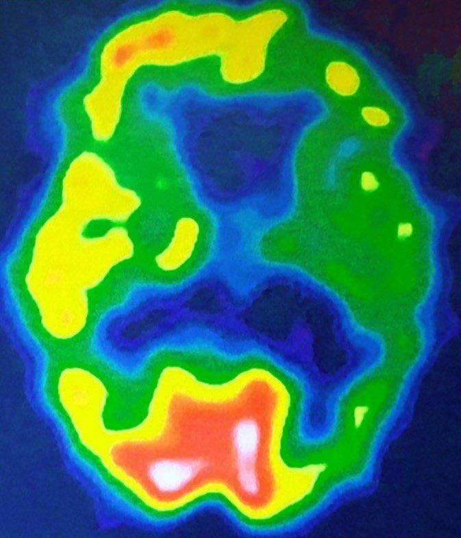 Crossed aphasia in a left-handed patient with non-fluent variant of primary progressive aphasia with left asymmetric brain SPECT.