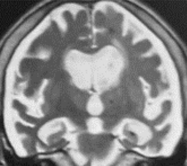 Crossed aphasia in a left-handed patient with non-fluent variant of primary progressive aphasia with left asymmetric brain SPECT.