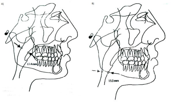 [Comparison of pharyngeal airway space on lateral head radiographs of skeletal class I and II individuals].