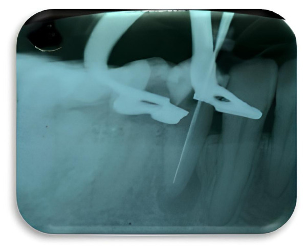 [Effectiveness of an irrigant in the chronic periapical abscess management: a case report].