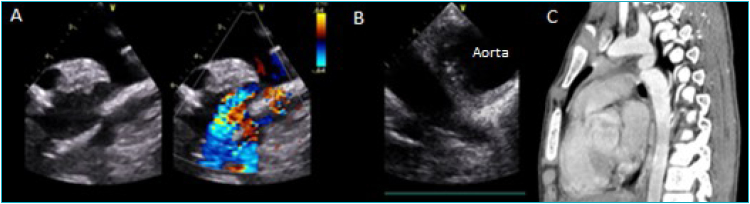 Infectious endarteritis in aortic coarctation: two spectra of an infrequent disease.