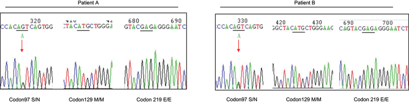 Two Chinese patients of sporadic Creutzfeldt-Jacob disease with a S97N mutation in <i>PRNP</i> gene.