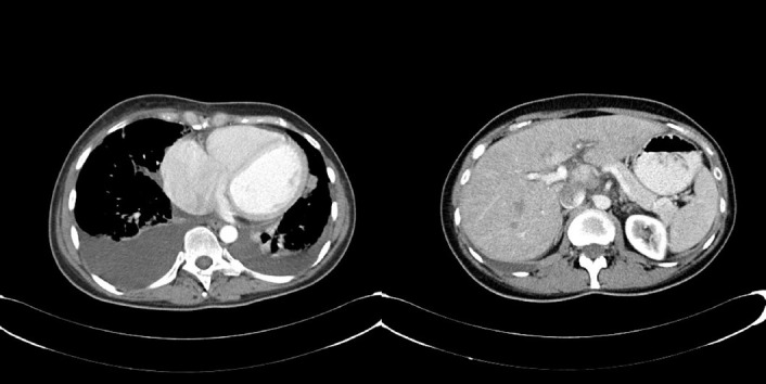 Toxic Cardiomyopathy in a Young Patient Treated for Her2-Positive Early Breast Cancer: Case Report and Literature Review.