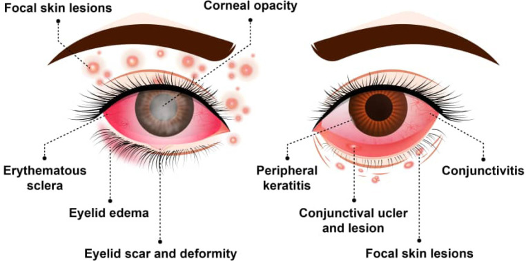 Monkeypox and the eye.