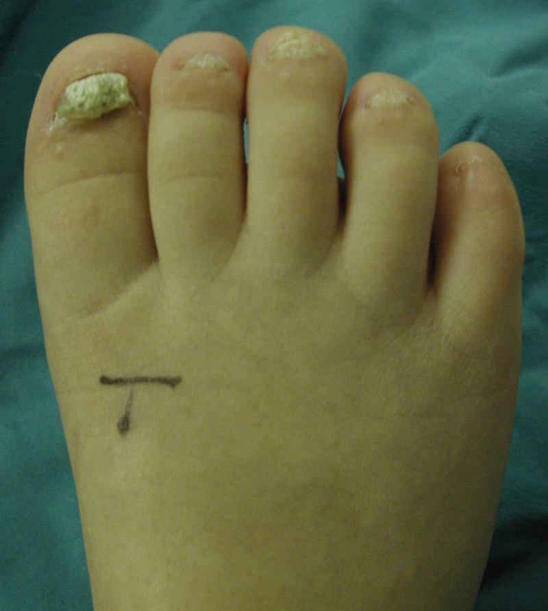 Surgical Management of Pachyonychia Congenita in a 3-Year-Old.
