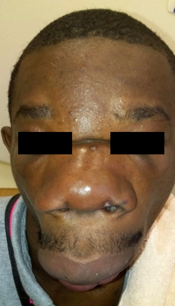[Conidiobolomycosis (rhinofacial entomophthoromycosis) in Gabon. About of one case].