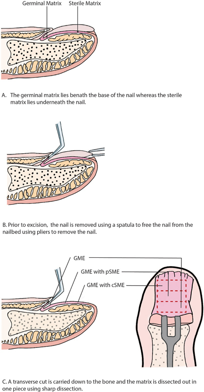 Surgical Management of Pachyonychia Congenita in a 3-Year-Old.
