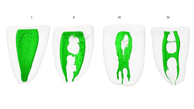 Morphological assessment of the isthmus in mesial root canals of first mandibular molars.