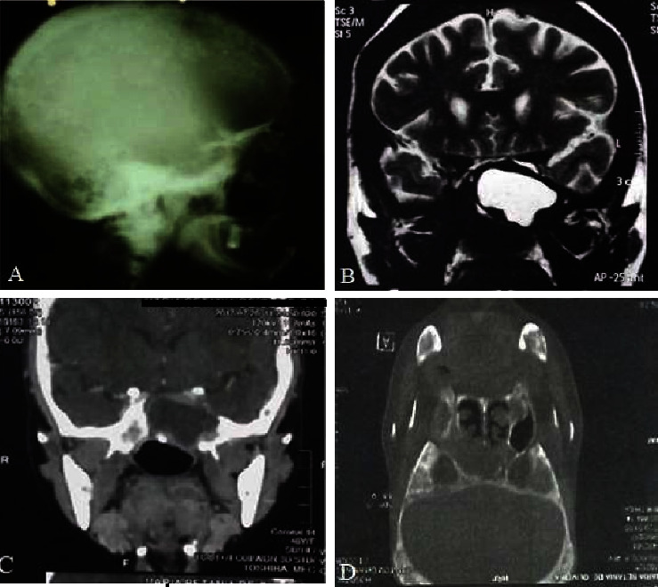 Hypopituitarism due to a Large Osteoclastoma Arising from the Sphenoid Bone Invading the Pituitary Fossa in a Patient with Parathyroid Carcinoma.
