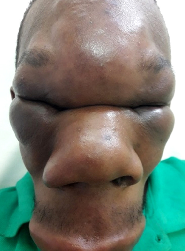 [Conidiobolomycosis (rhinofacial entomophthoromycosis) in Gabon. About of one case].
