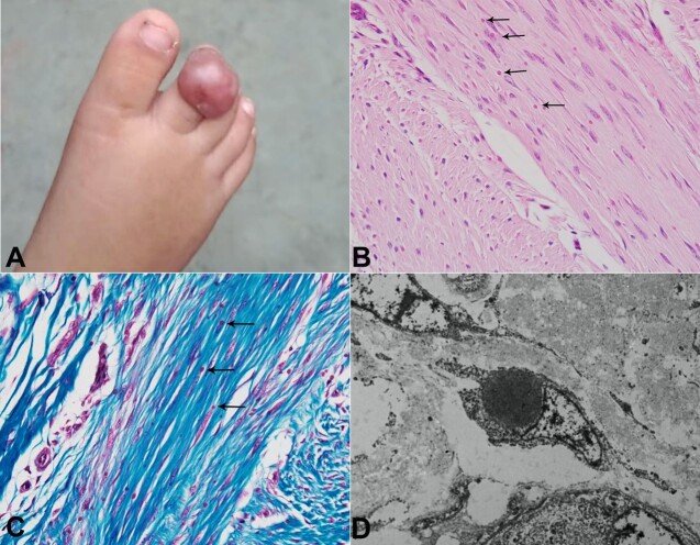 Inclusion body fibromatosis.