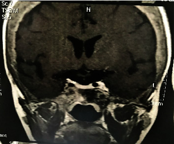 Hypopituitarism due to a Large Osteoclastoma Arising from the Sphenoid Bone Invading the Pituitary Fossa in a Patient with Parathyroid Carcinoma.
