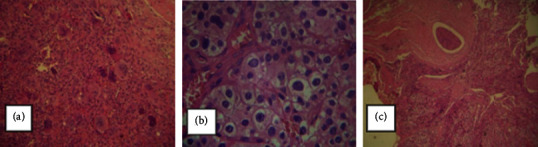 Hypopituitarism due to a Large Osteoclastoma Arising from the Sphenoid Bone Invading the Pituitary Fossa in a Patient with Parathyroid Carcinoma.