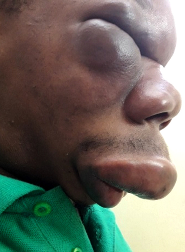 [Conidiobolomycosis (rhinofacial entomophthoromycosis) in Gabon. About of one case].