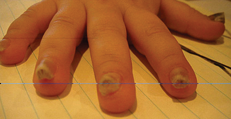 Surgical Management of Pachyonychia Congenita in a 3-Year-Old.