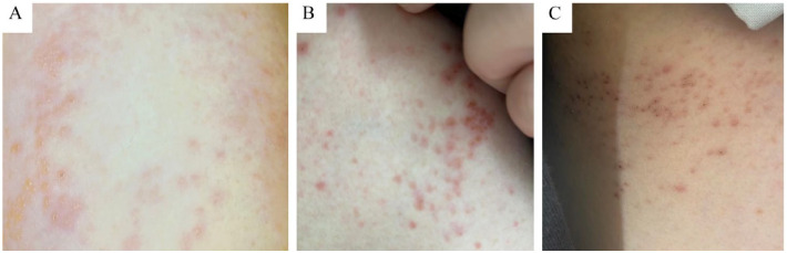 Rethinking the Utility of the Audio-Only Encounter: A Case of Herpes Zoster Co-Infection in Asymptomatic SARS-CoV-2.