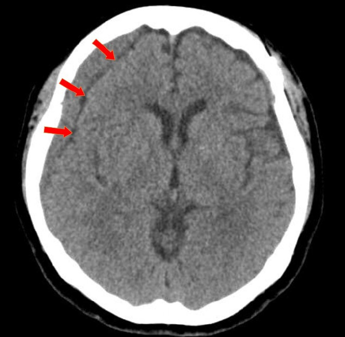Natural course of chronic subdural hematoma following surgical clipping of unruptured intracranial aneurysm by pterional approach.