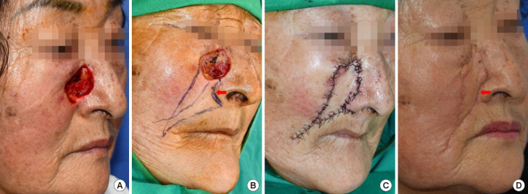 Alar crease as a donor site for the extension limb of modified nasolabial V-Y advancement flap.