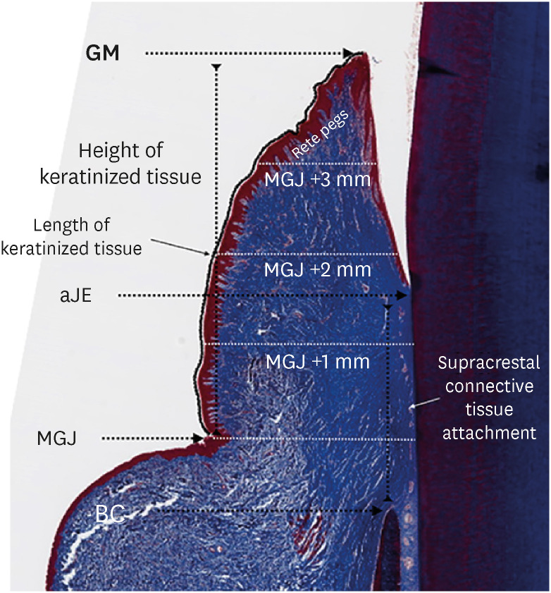 Effect of polydeoxyribonucleotide with xenogeneic collagen matrix on gingival phenotype modification: a pilot preclinical study.