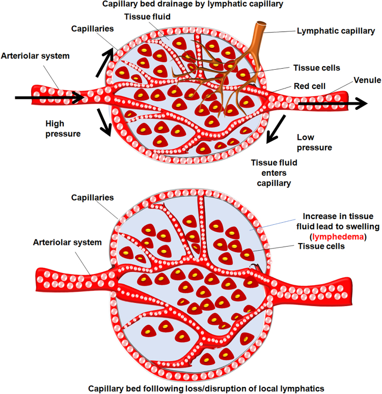 Recent Advances in Therapeutic Modalities Against Breast Cancer-Related Lymphedema: Future Epigenetic Landscape.