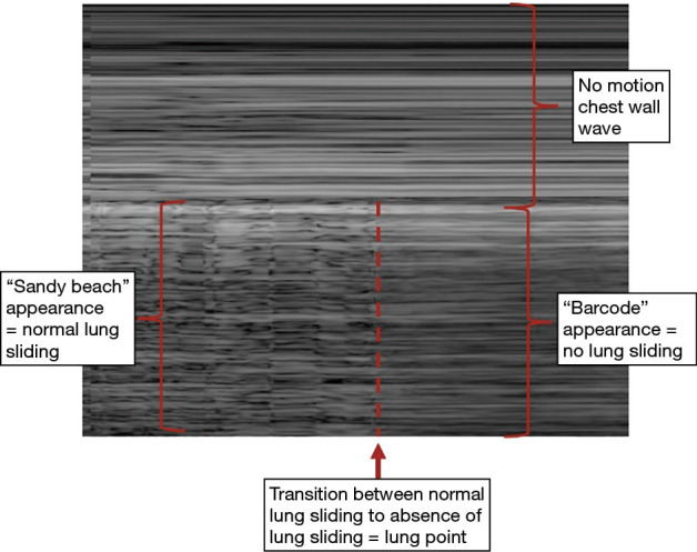 Pneumomediastinum and pneumothorax in acute respiratory distress syndrome (ARDS) patients: a narrative review.