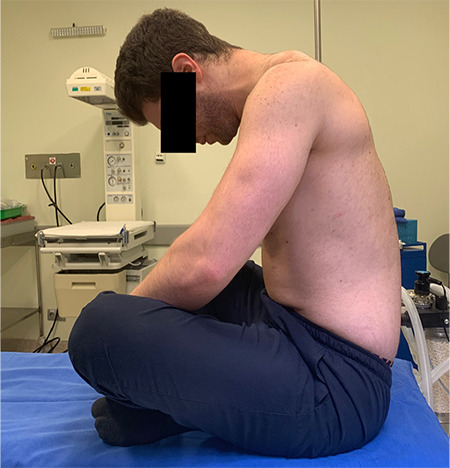 Comparison of Two Different Positions for Ultrasound-Guided Intervertebral Distance Evaluation.