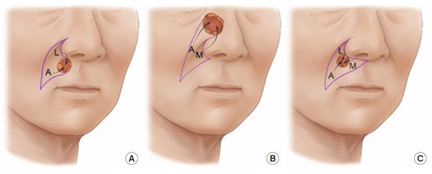 Alar crease as a donor site for the extension limb of modified nasolabial V-Y advancement flap.