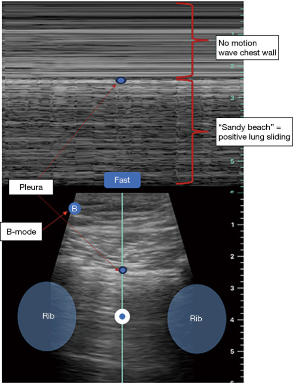 Pneumomediastinum and pneumothorax in acute respiratory distress syndrome (ARDS) patients: a narrative review.