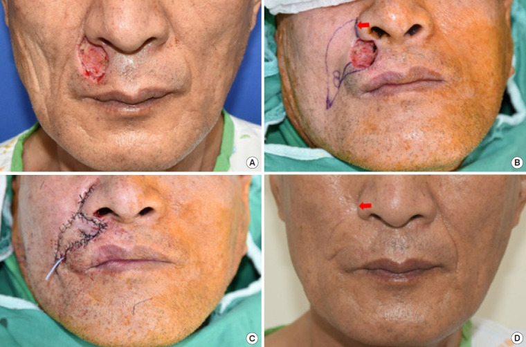 Alar crease as a donor site for the extension limb of modified nasolabial V-Y advancement flap.