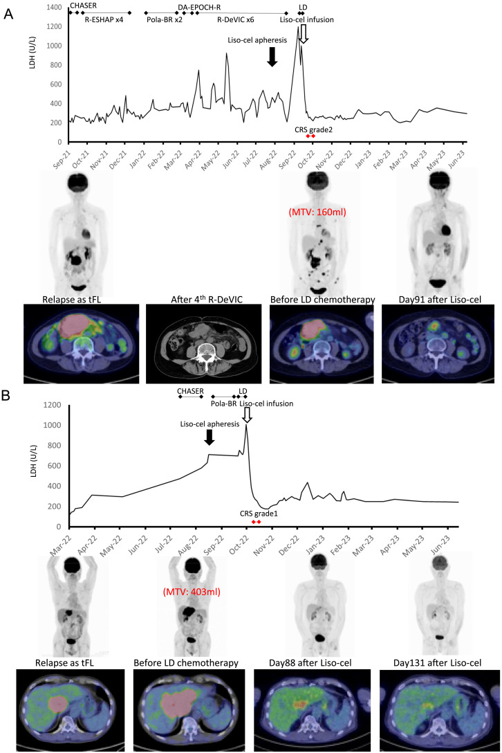Significant response of patients with transformed follicular lymphoma with rapid disease progression to CAR-T therapy.