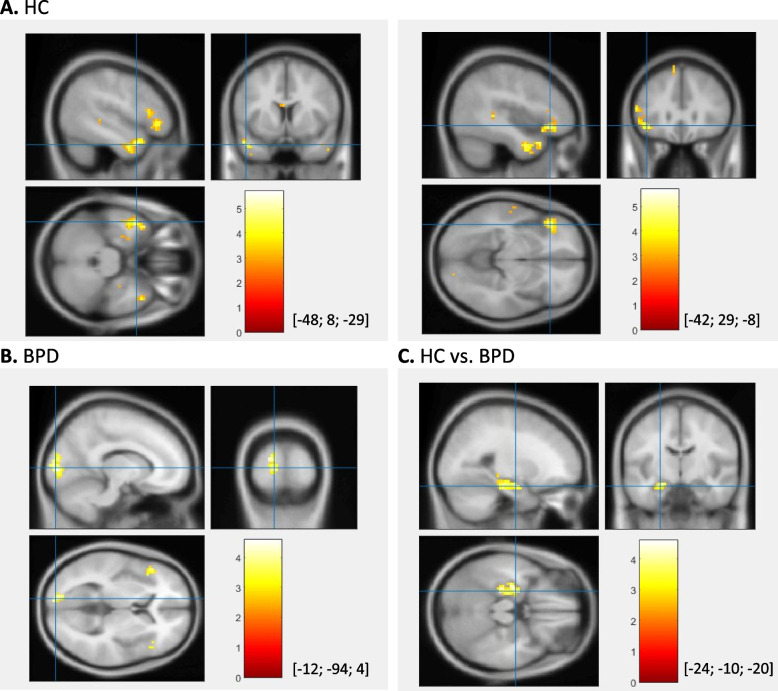 Neural correlates of social exclusion and overinclusion in patients with borderline personality disorder: an fMRI study.
