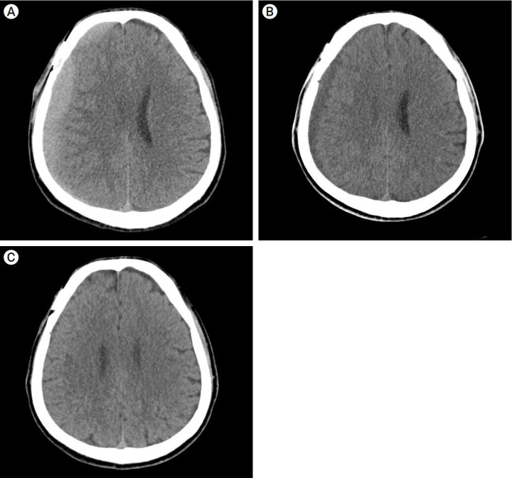 Natural course of chronic subdural hematoma following surgical clipping of unruptured intracranial aneurysm by pterional approach.