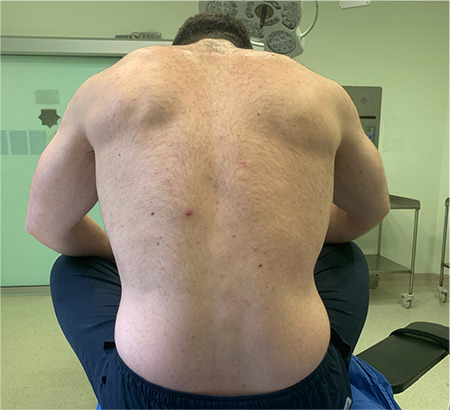 Comparison of Two Different Positions for Ultrasound-Guided Intervertebral Distance Evaluation.