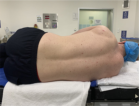 Comparison of Two Different Positions for Ultrasound-Guided Intervertebral Distance Evaluation.