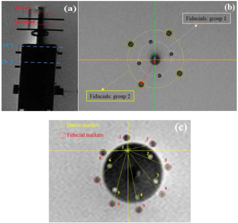 Quantification of Artifacts and Image Distortions in 1.5 Tesla Magnetic Resonance Images of a Commercial Multi-Channel Vaginal Cylinder Brachytherapy Applicator Set.