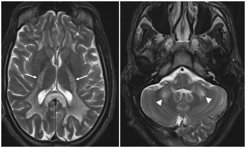 The dangers of "Chasing the dragon": a fatal case of heroin-induced leukoencephalopathy.