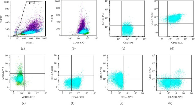 MPO Expression of Background Neutrophils in MPO Negative Acute Promyelocytic Leukemia, An Easy Clue to Corroborate a Challenging Diagnosis: A Case Report and Review of Literature.