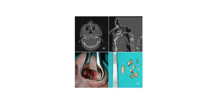 Intranasal supernumerary tooth: two case reports and review of the literature.