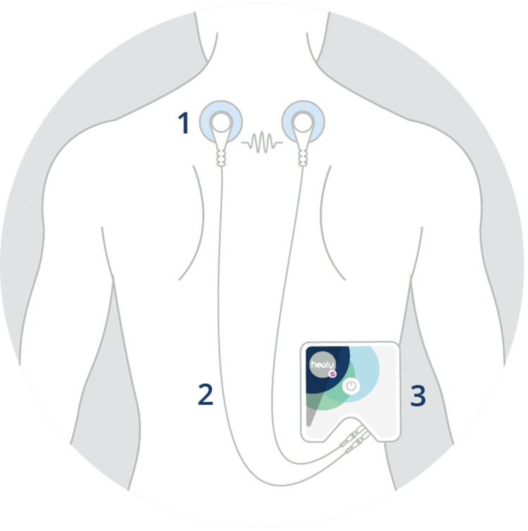 Observational Study to Assesses the Efficacy and Safety of Microcurrent Therapy with a Portable Device in Patients Suffering from Chronic Back Pain, Skeletal System Pain, Fibromyalgia, Migraine or Depression.